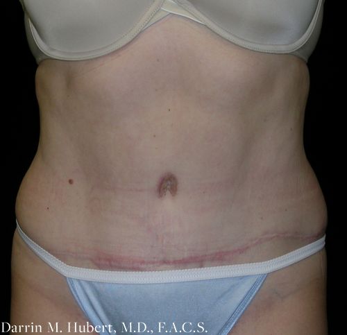 Real patient tummy tuck after photo