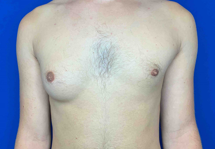 Real patient gynecomastia before photo